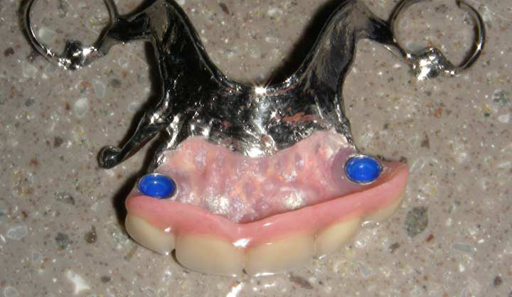 Removable Partial Denture