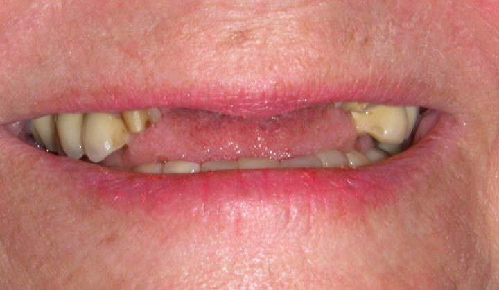 Removable Partial Dentures - Before