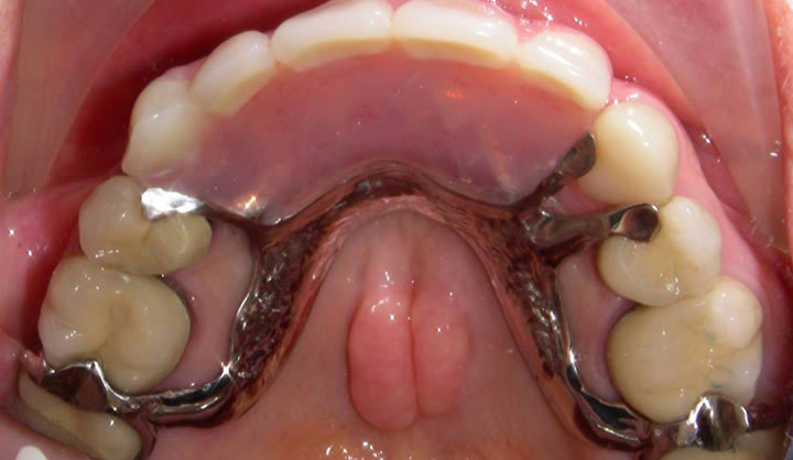 Implant Retained Removable Partial Denture