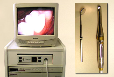 Intra-Oral-Camera