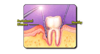 Dental Bridge