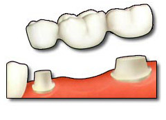 Dental Bridge