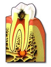 Dental Root Canal Therapy