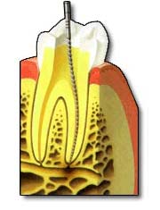 Dental Root Canal Therapy