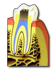 Dental Root Canal Therapy