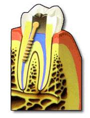 Dental Root Canal Therapy